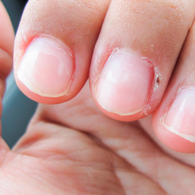 Morderse las uñas, al morderte las uñas, las deformas y creas relieves indeseables que, a larga, pueden ser permanentes. Además, generas más humedad en ellas, y propicias la aparición de bacterias.